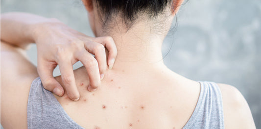 Comment se débarrasser de l'acné du dos ?